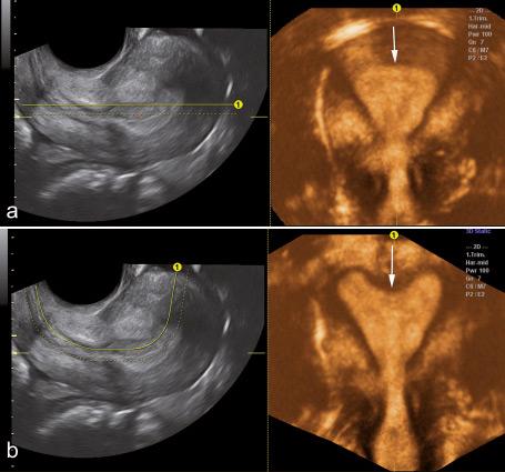 Preliminary experience with Advanced Volume Contrast Imaging (VCI) and Omniview in obstetric and gynecologic ultrasound